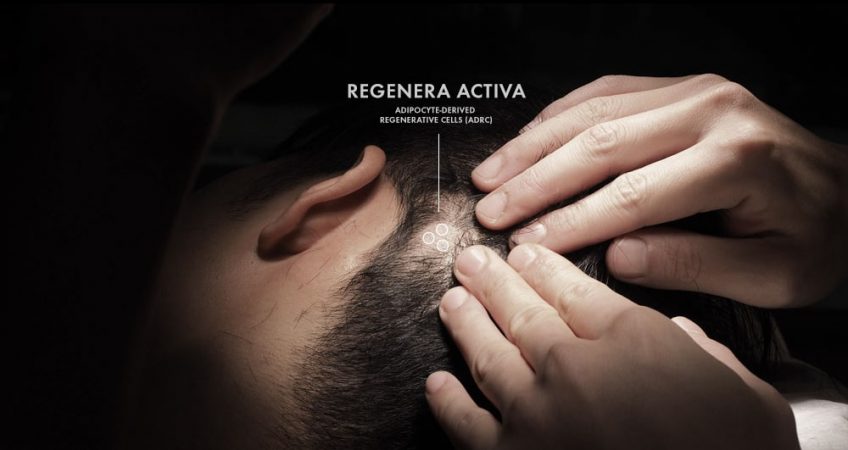 regenera activa micrograft stem cells from scalp
