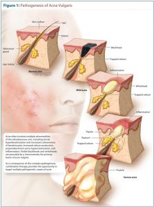 Acne: Types, Causes, Treatments and Tips for Prevention - Dr Rachel Ho