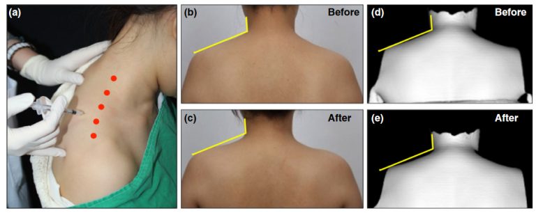 Dr Rachel Ho | TrapTox: Shoulder Contouring with Trapezius Botox Injections