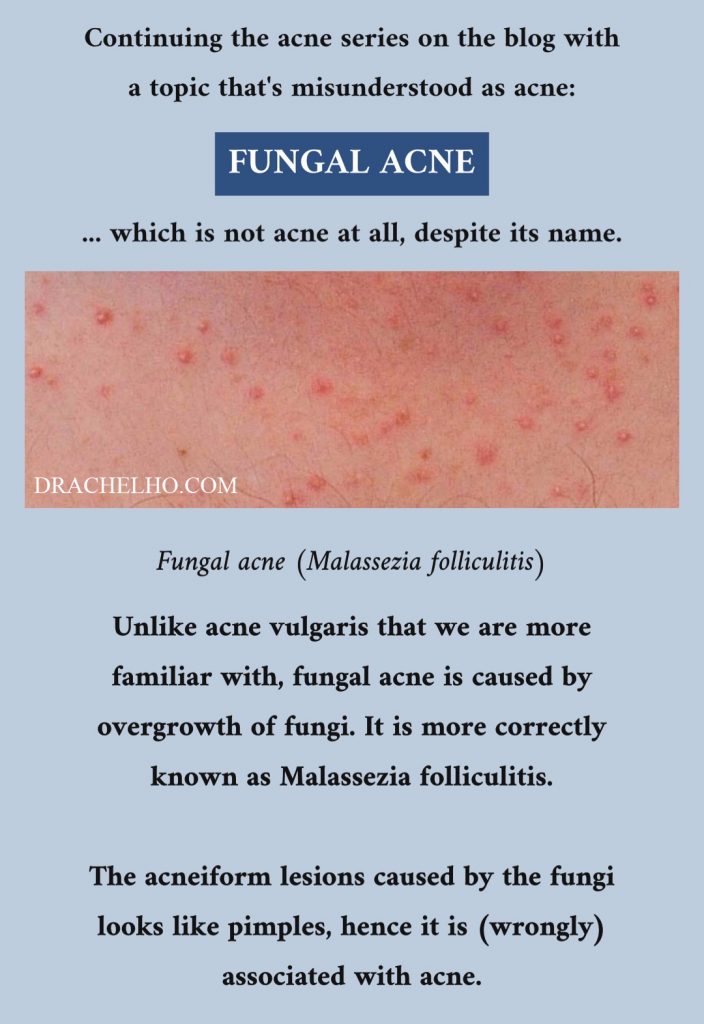Dr Rachel Ho | Fungal Acne is Not Acne At All: Malassezia Folliculitis ...