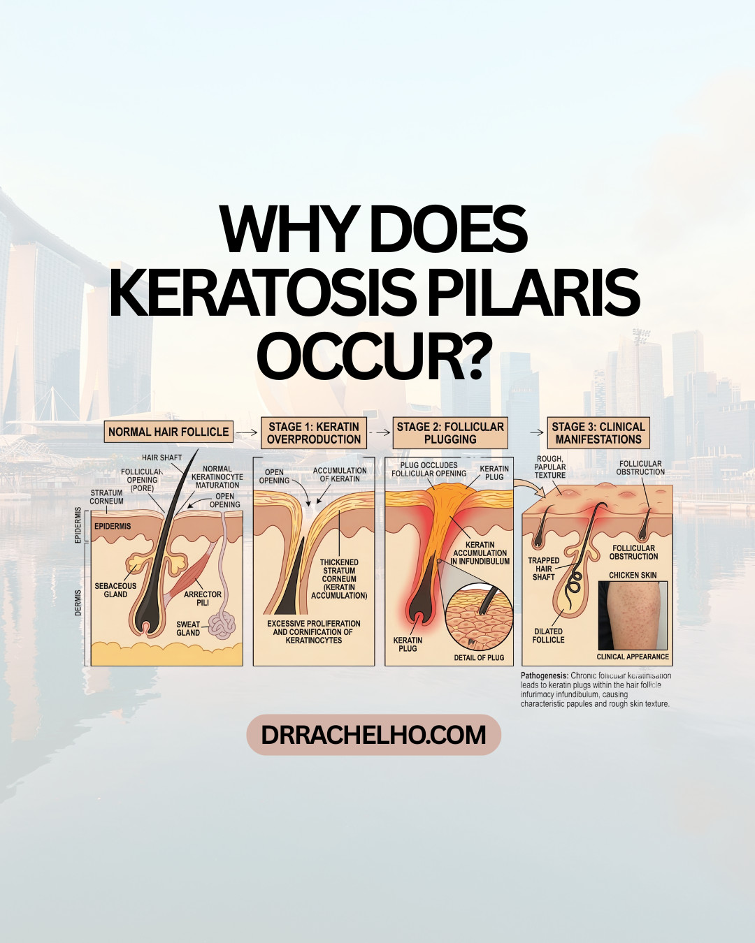 Chicken Skin Type Rash Keratosis Pilaris (Chicken Skin) in Singapore: Doctor's Guide - Dr ...