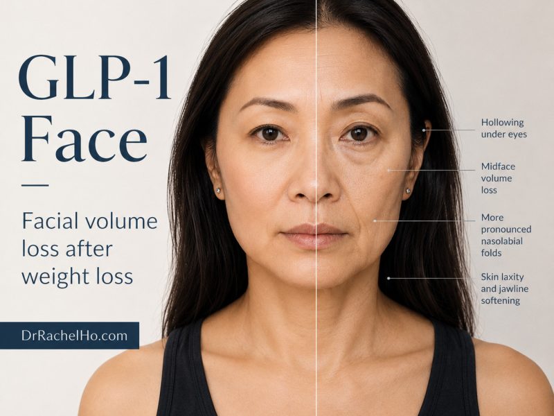 GLP 1 face showing facial volume loss, under eye hollowing, cheek volume loss and jawline laxity after weight loss