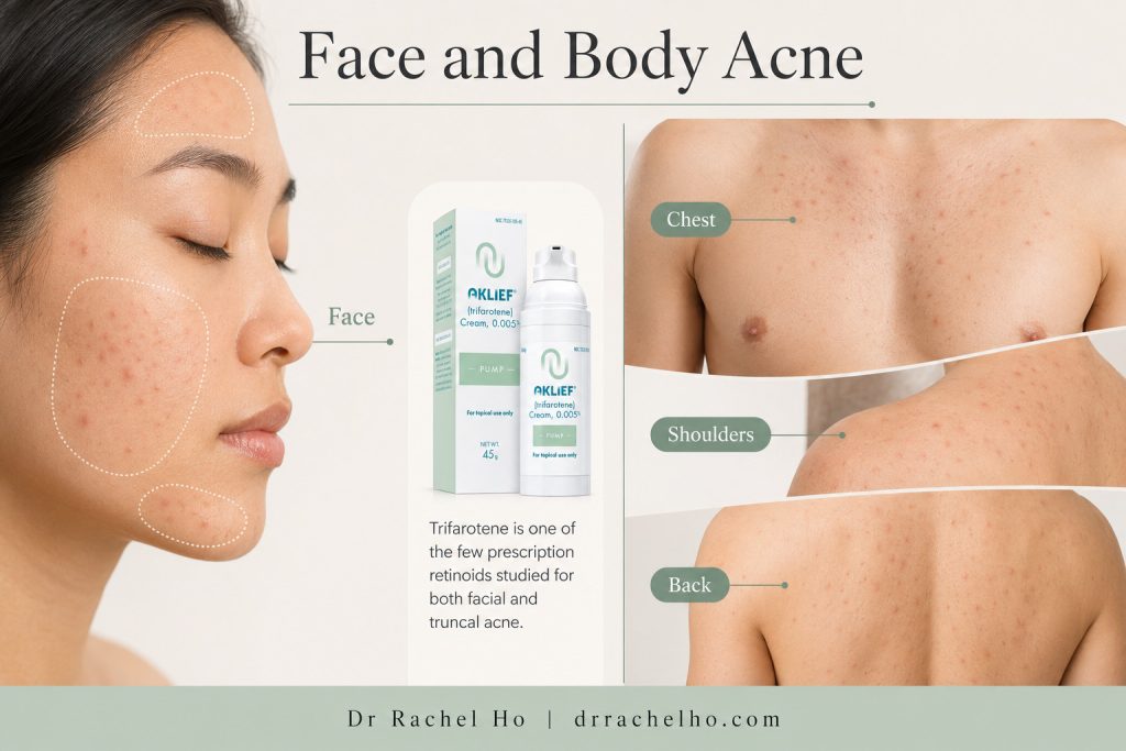Hyperrealistic facial, chest, shoulder and back acne showing the treatment areas studied for topical trifarotene.