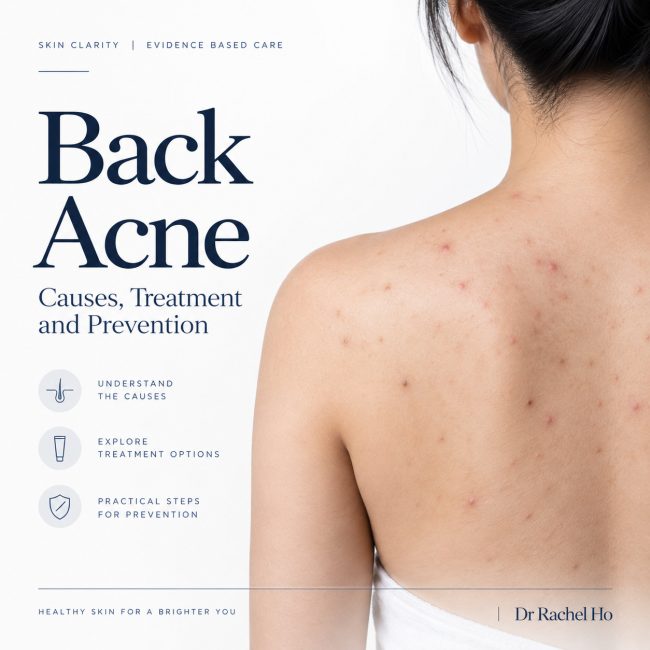 Back acne guide cover with a realistic illustration of upper back breakouts beside the title Causes, Treatment and Prevention.