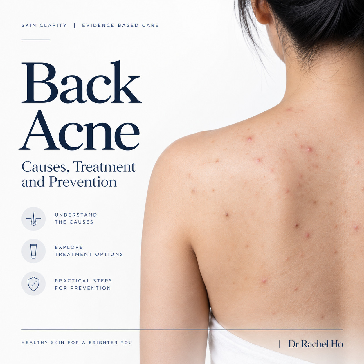 Back acne guide cover with a realistic illustration of upper back breakouts beside the title Causes, Treatment and Prevention.