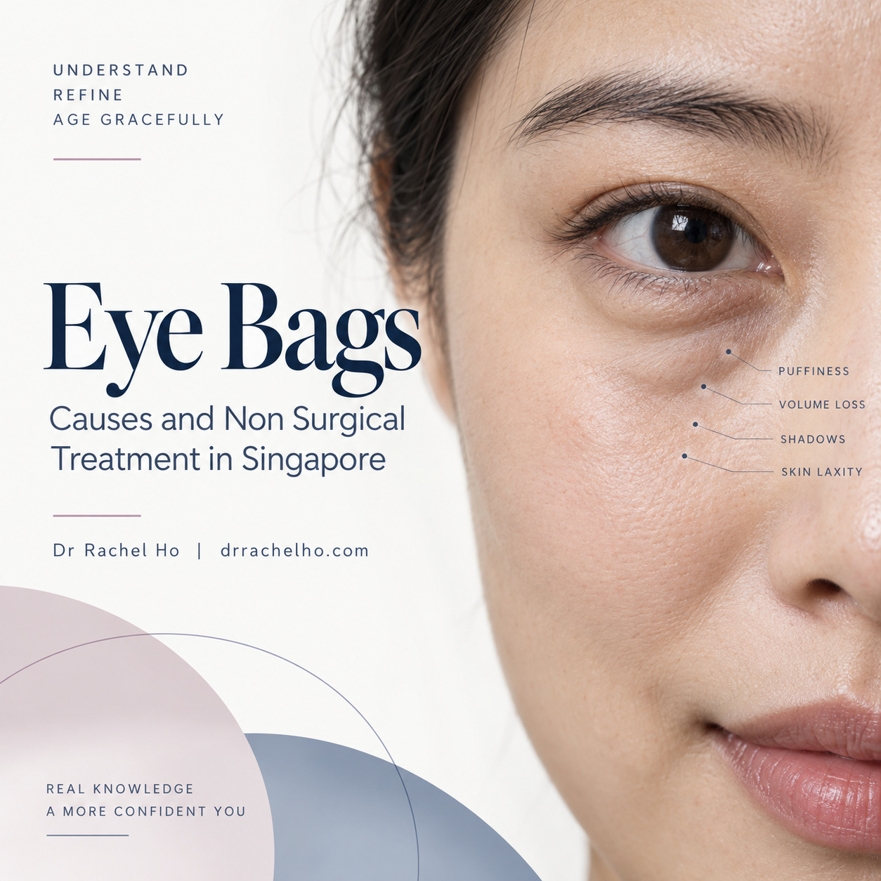 Eye bags guide by Dr Rachel Ho, with a lower eyelid illustration and an introduction to causes and non surgical treatment in Singapore.