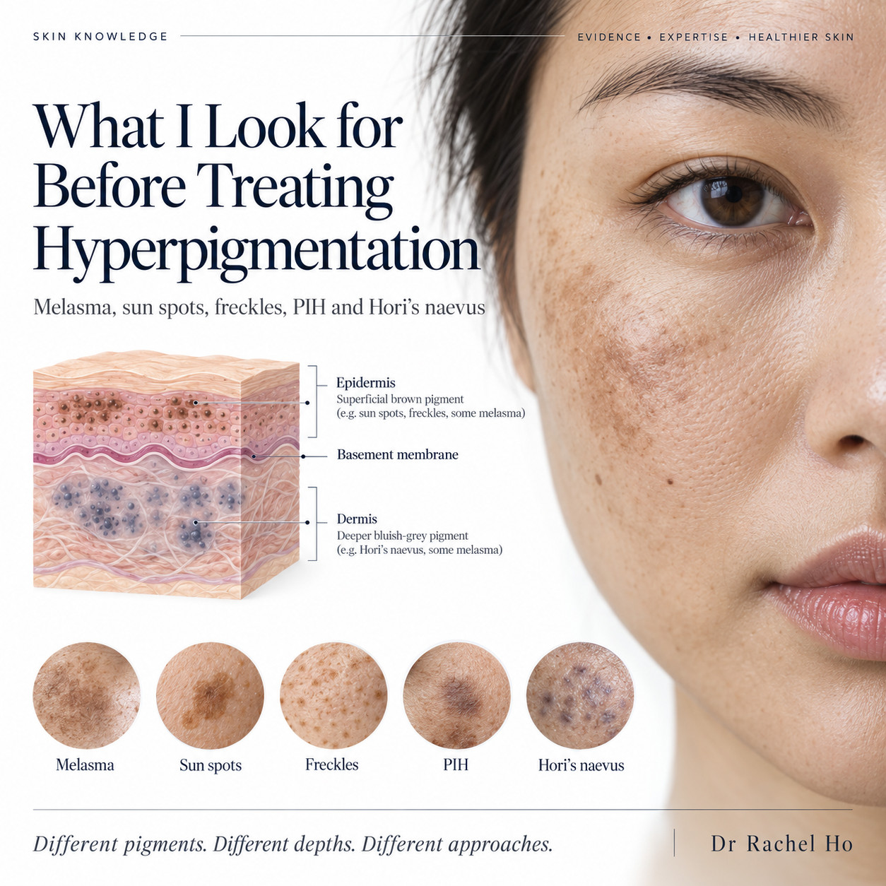 Hyperpigmentation guide with an illustrated cheek close-up, a skin depth diagram and five examples of facial pigmentation.