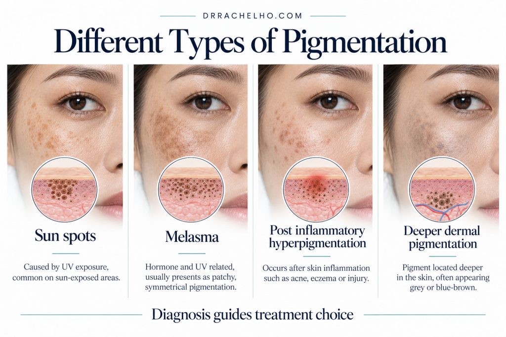 Infographic showing sun spots, melasma, post inflammatory hyperpigmentation and deeper dermal pigmentation