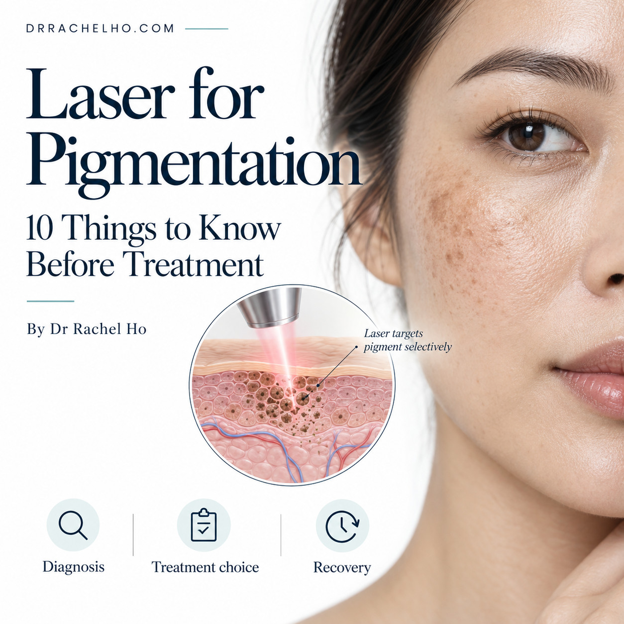 Laser for pigmentation cover image showing facial dark spots and a medical illustration of laser targeting pigment in the skin