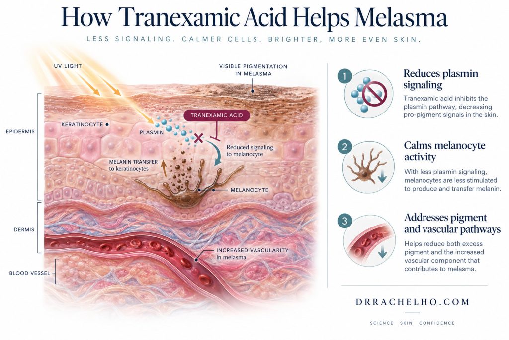Skin diagram showing ultraviolet light, plasmin signalling and melanocytes in an explanation of tranexamic acid for melasma.